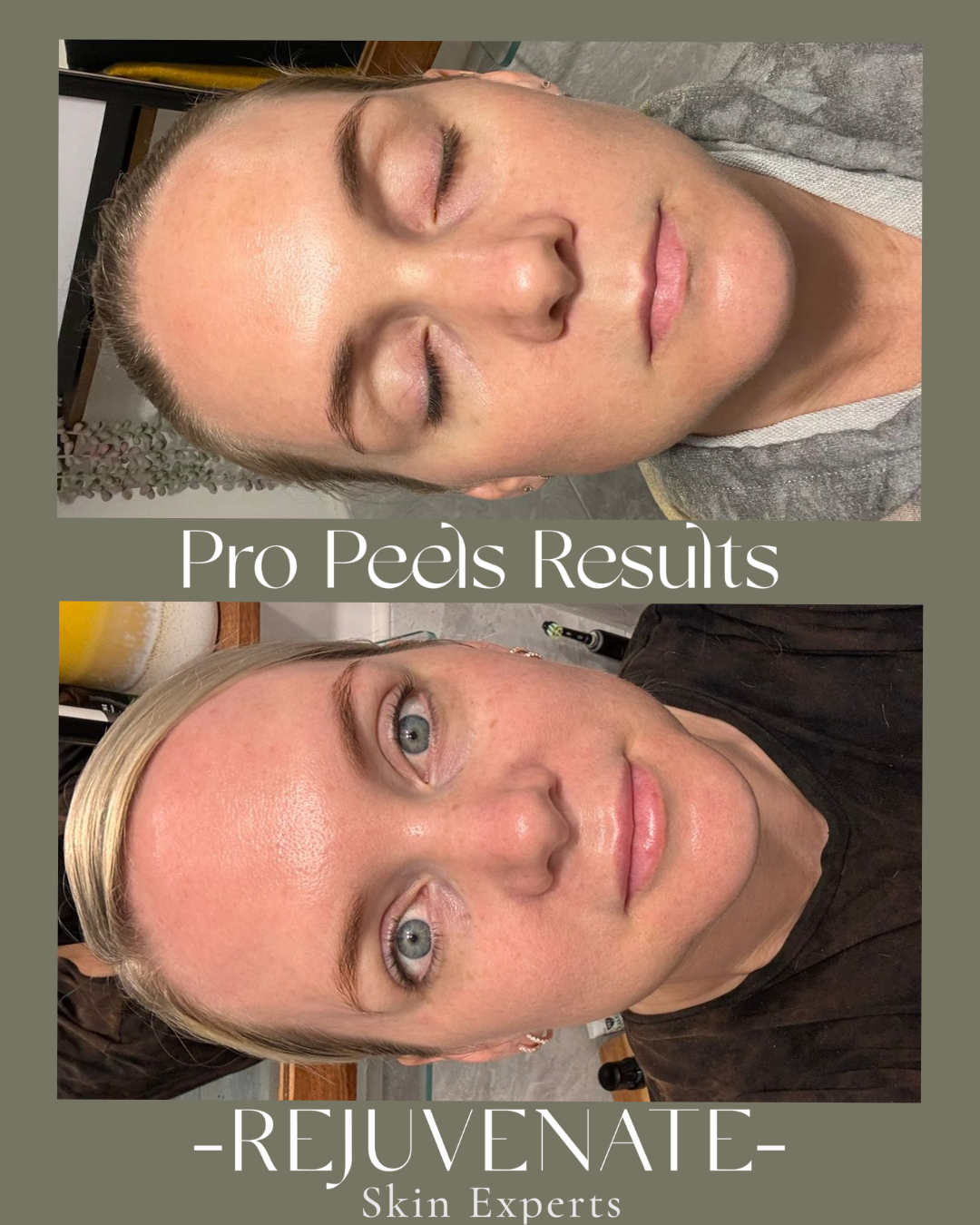 Chemical Face Peel